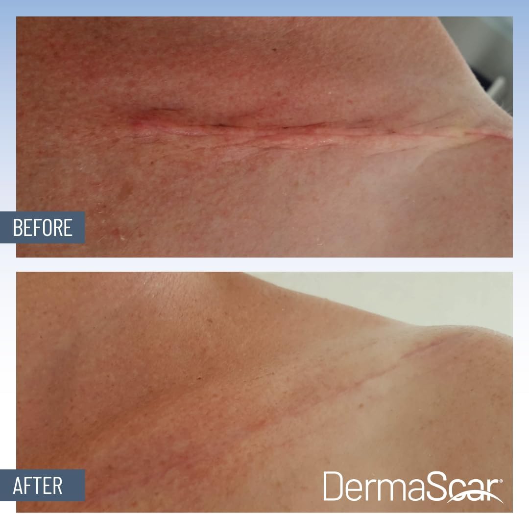 Classic Gel Platinum C & E - 15 grams. Medical Grade Silicone Gel for Scar Reduction - With Added Antioxidants Vitamin C (1%) & Vitamin E (10%) - Acne, Scar Treatment Cream - Tube Packaging
