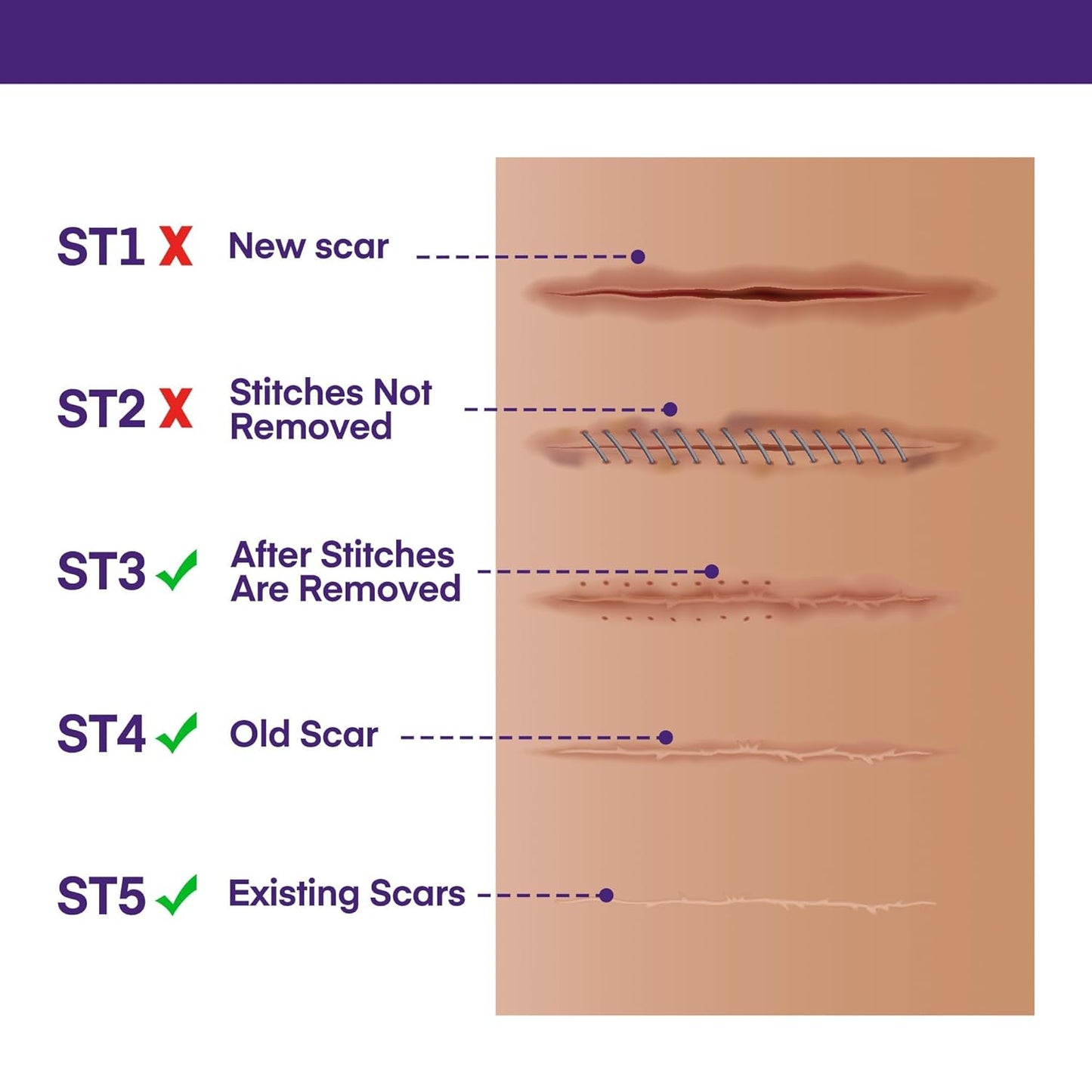 Silicone Scar Gel Scar Cream: SPF 30 Advanced Medical-Grade Formula for Surgical Scars, C-Section, Stretch Marks, Acne, Burns, Keloids, Old & New Scars – Broad Spectrum UV Protection 1.06oz (30g)