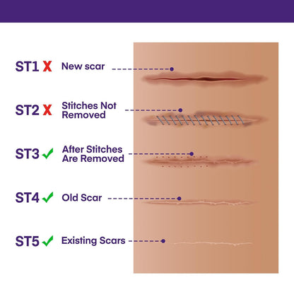 Silicone Scar Gel Scar Cream: SPF 30 Advanced Medical-Grade Formula for Surgical Scars, C-Section, Stretch Marks, Acne, Burns, Keloids, Old & New Scars – Broad Spectrum UV Protection 1.06oz (30g)