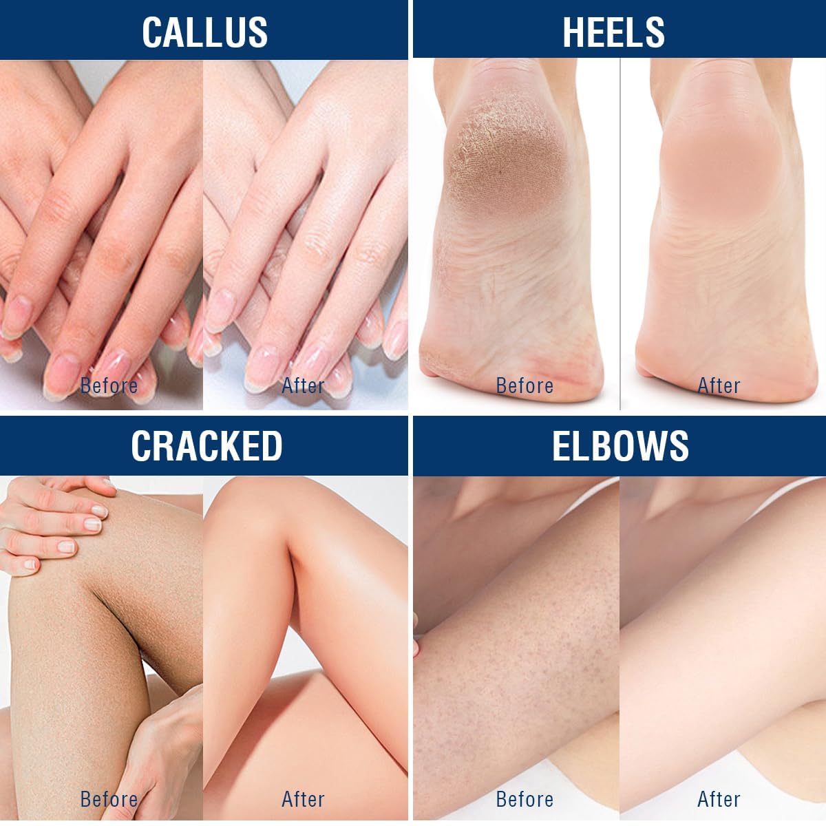 OUKEYA Urea Cream 40 Percent,Foot & Hand Cream for Dry Cracked,Urea Lotion for Feet Maximum Strength