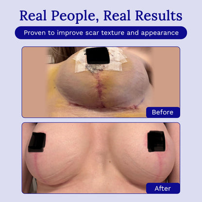 Rejuvaskin Scar Heal Kit for Breast Scars, Soften, Flatten, Reduce and Recover, Silicone Sheeting, RejuvaSil Gel & Medical Tape, Breast Anchor Pair