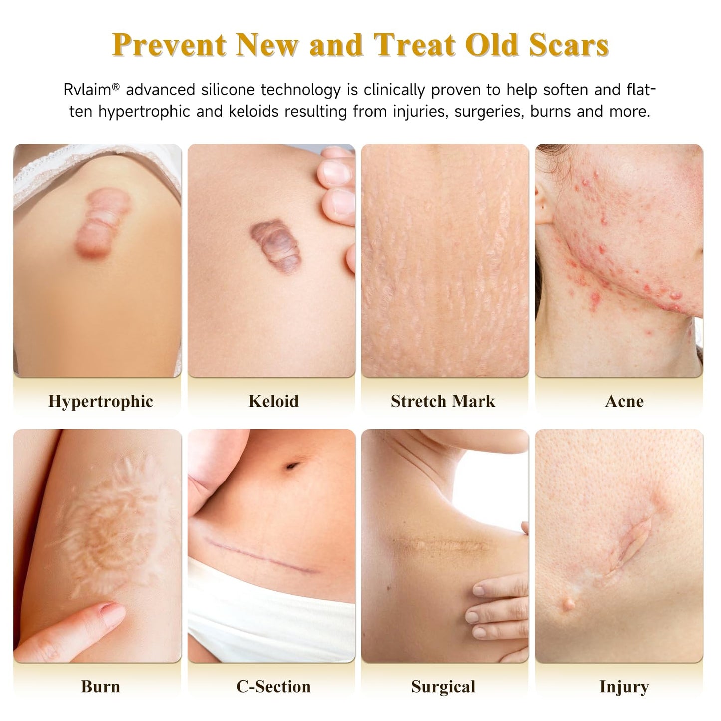 Scar Cream Silicone Scar Gel, Scar Cream for Surgical Scars, Advanced Scar Removal Cream for C-Section, Injury, Acne, Burns, Keloids, Stretch Marks, Old & New Scars, 1.85 Oz (55g)