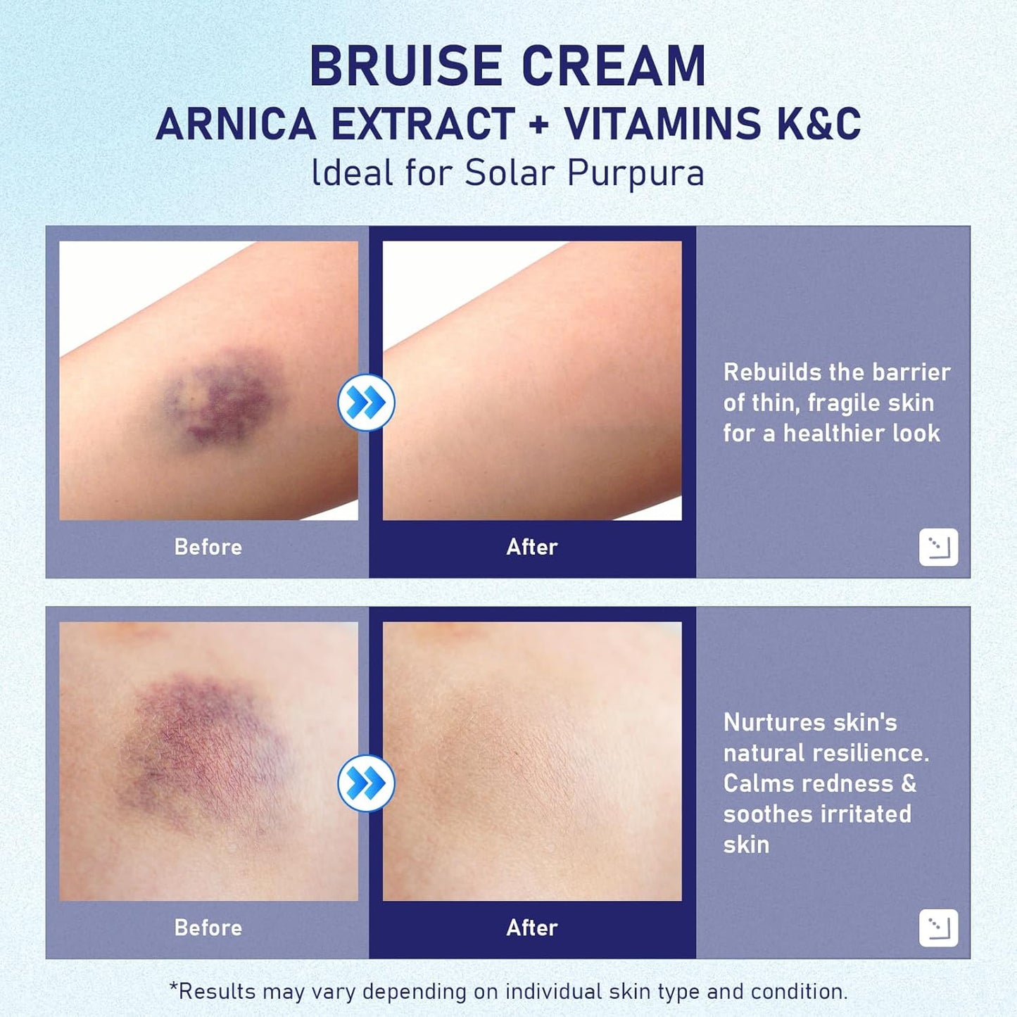 Bruise Cream for Thin Skin Seniors (3.53 Oz)