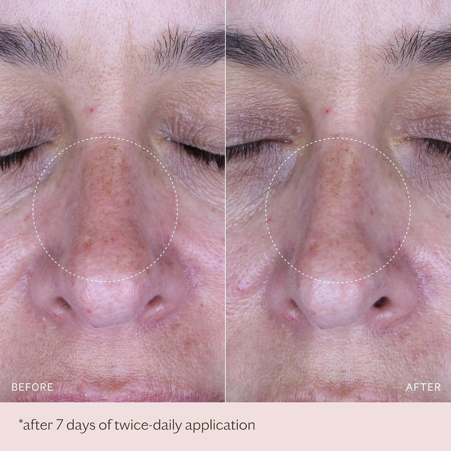 MZ SKIN Pigmentation Correcting Ampoules 0.06 fl oz x 14 | 7-Day Brightening Treatment with Tranexamic Acid & Alpha Arbutin | For Dark Spots & Uneven Skin Tone