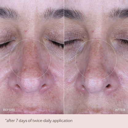 MZ SKIN Pigmentation Correcting Ampoules 0.06 fl oz x 14 | 7-Day Brightening Treatment with Tranexamic Acid & Alpha Arbutin | For Dark Spots & Uneven Skin Tone