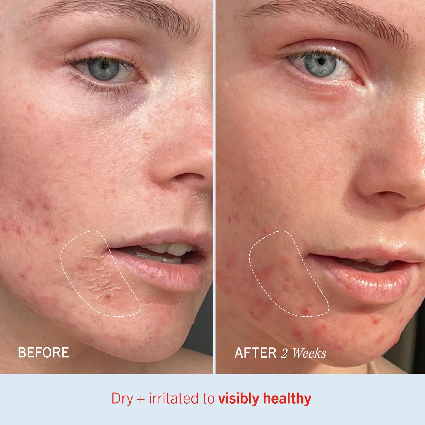 First Aid Beauty Ultra Repair Cream – Eczema Relief & Skin Barrier Repair Moisturizer with Colloidal Oatmeal & Ceramides, for Sensitive Dry Skin, Face & Body, 170.1g