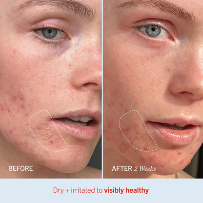 First Aid Beauty Ultra Repair Cream – Eczema Relief & Skin Barrier Repair Moisturizer with Colloidal Oatmeal & Ceramides, for Sensitive Dry Skin, Face & Body, 170.1g