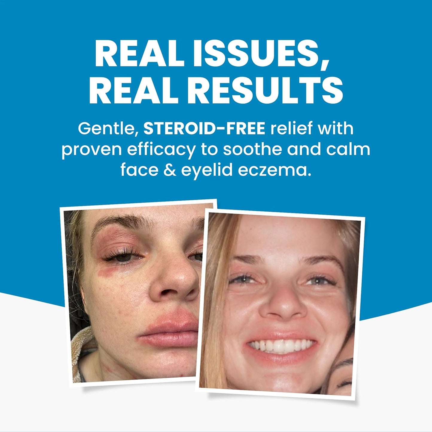 Grahams Natural Face & Eyelid Eczema Relief Kit - Treatment for Dry Skin, Eczema, Perioral & Seborrheic Dermatitis - Itch Relief - Moisturizing Face Cream, 75g + Eyelid Oil, 50ml
