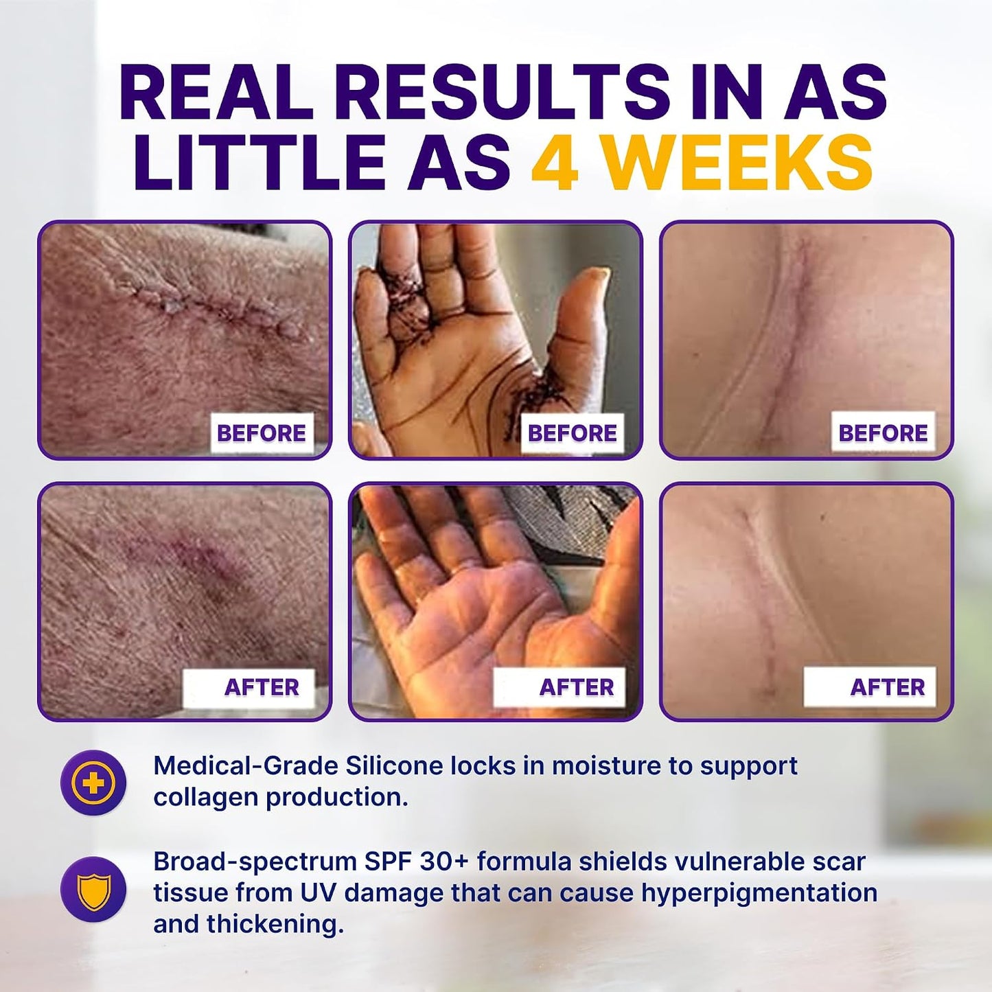 Silicone Scar Gel Day & Night Set - 100% Medical-Grade Silicone + SPF 30 Scar Cream for Surgical Scars, C-Section, Burns, Acne, Stretch Marks, Keloids – 1.06oz x 2 Tubes