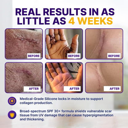 Silicone Scar Gel Day & Night Set - 100% Medical-Grade Silicone + SPF 30 Scar Cream for Surgical Scars, C-Section, Burns, Acne, Stretch Marks, Keloids – 1.06oz x 2 Tubes