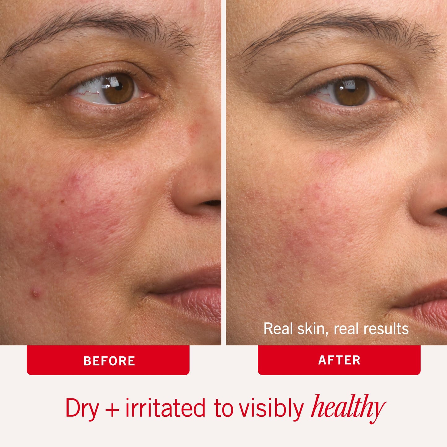 First Aid Beauty Ultra Repair Cream – Eczema Relief & Skin Barrier Repair Moisturizer with Colloidal Oatmeal & Ceramides, for Sensitive Dry Skin, Face & Body, 170.1g
